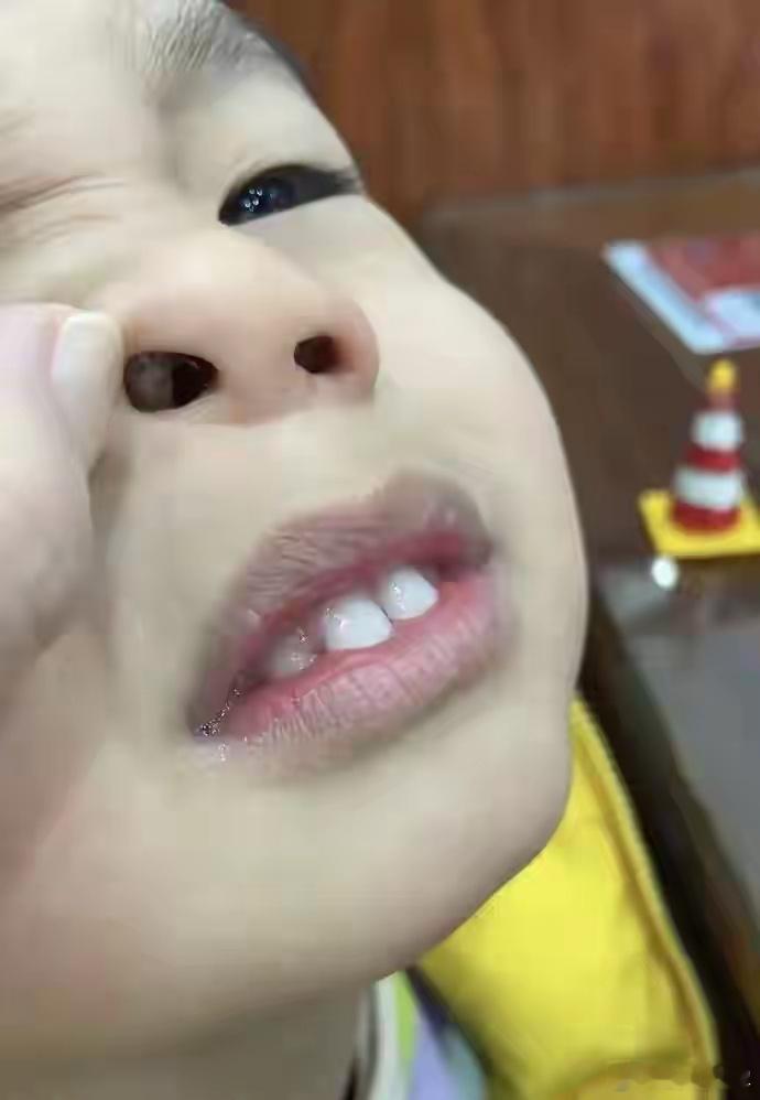 清代名方消瘰丸：专克腺样体肥大现在在儿童疾病里，腺样体肥大越来越普遍了，西医遇