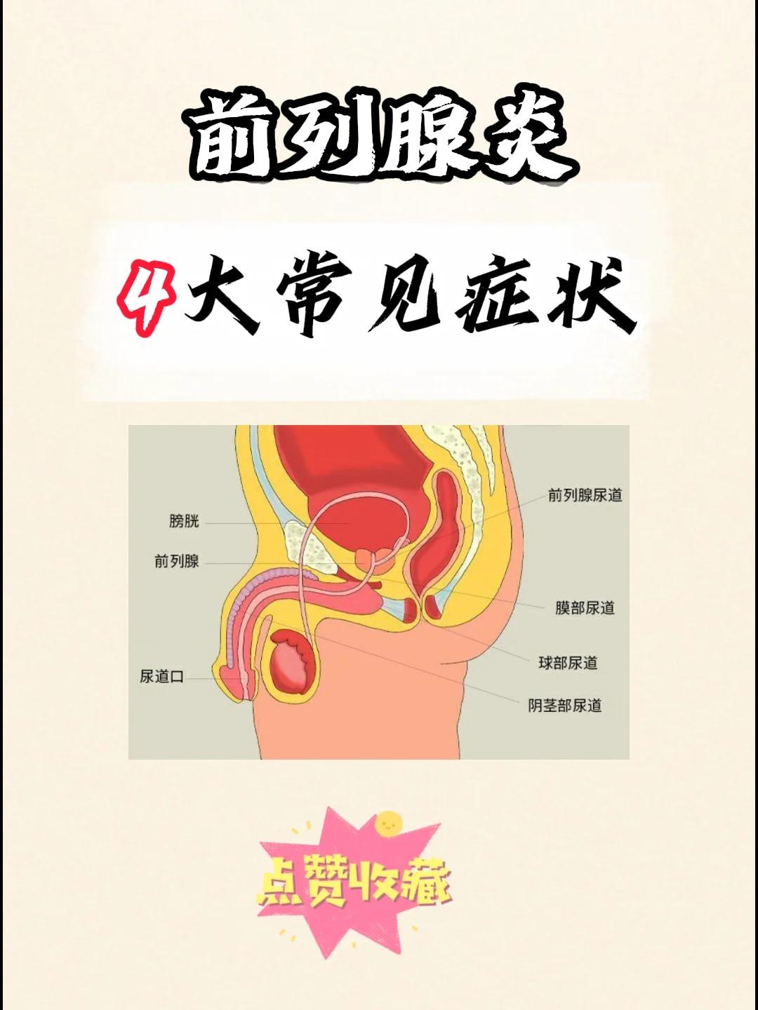 前列腺炎常见的4大症状，快看看你有没有？