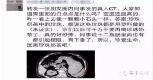 胃部CT里石子样的白点 是奶茶里的珍珠?