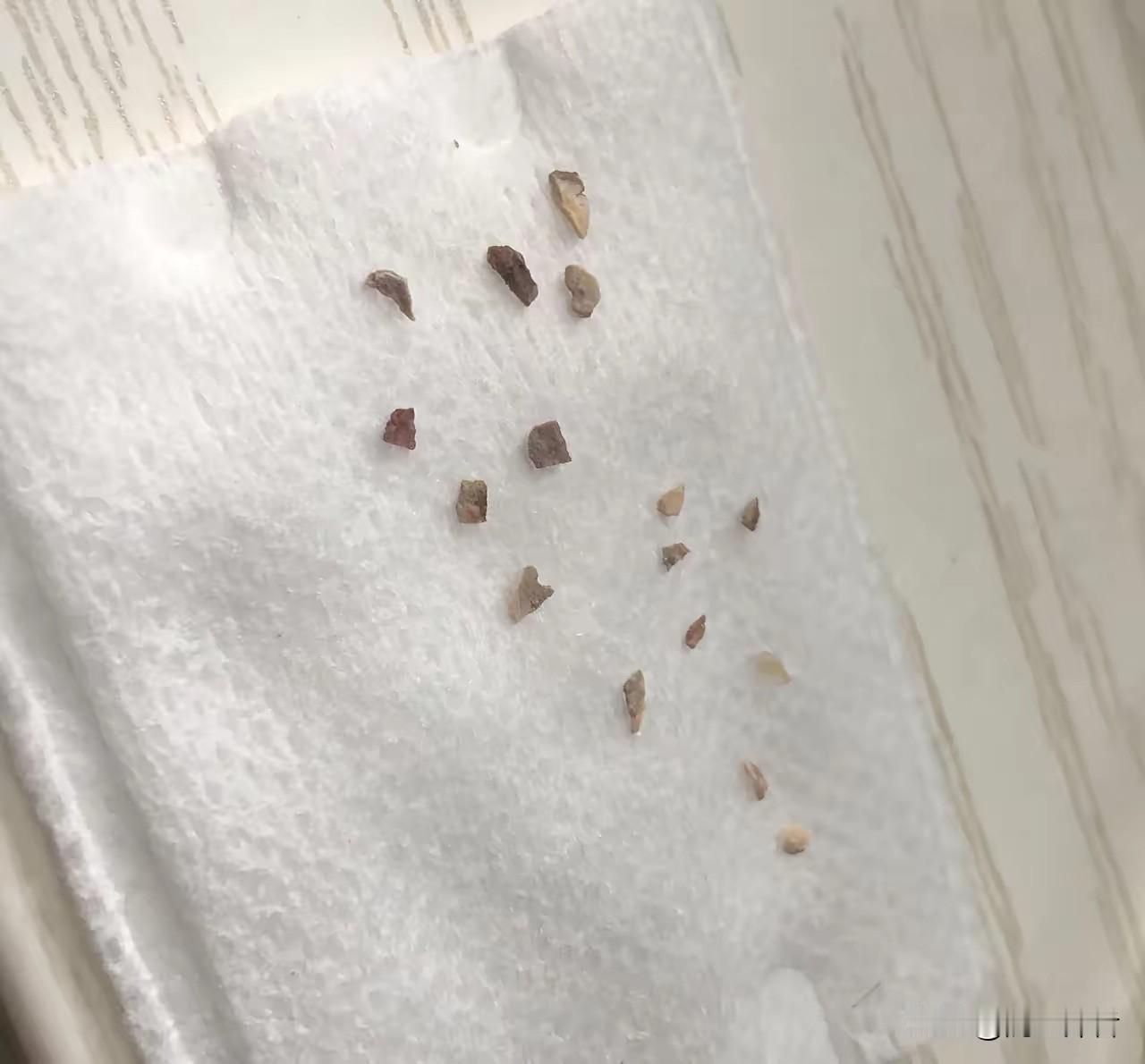 牙齿上有牙垢和结石了要不要洗牙?今天牙齿上的牙垢掉了一块，用舌头舔特别不自在。