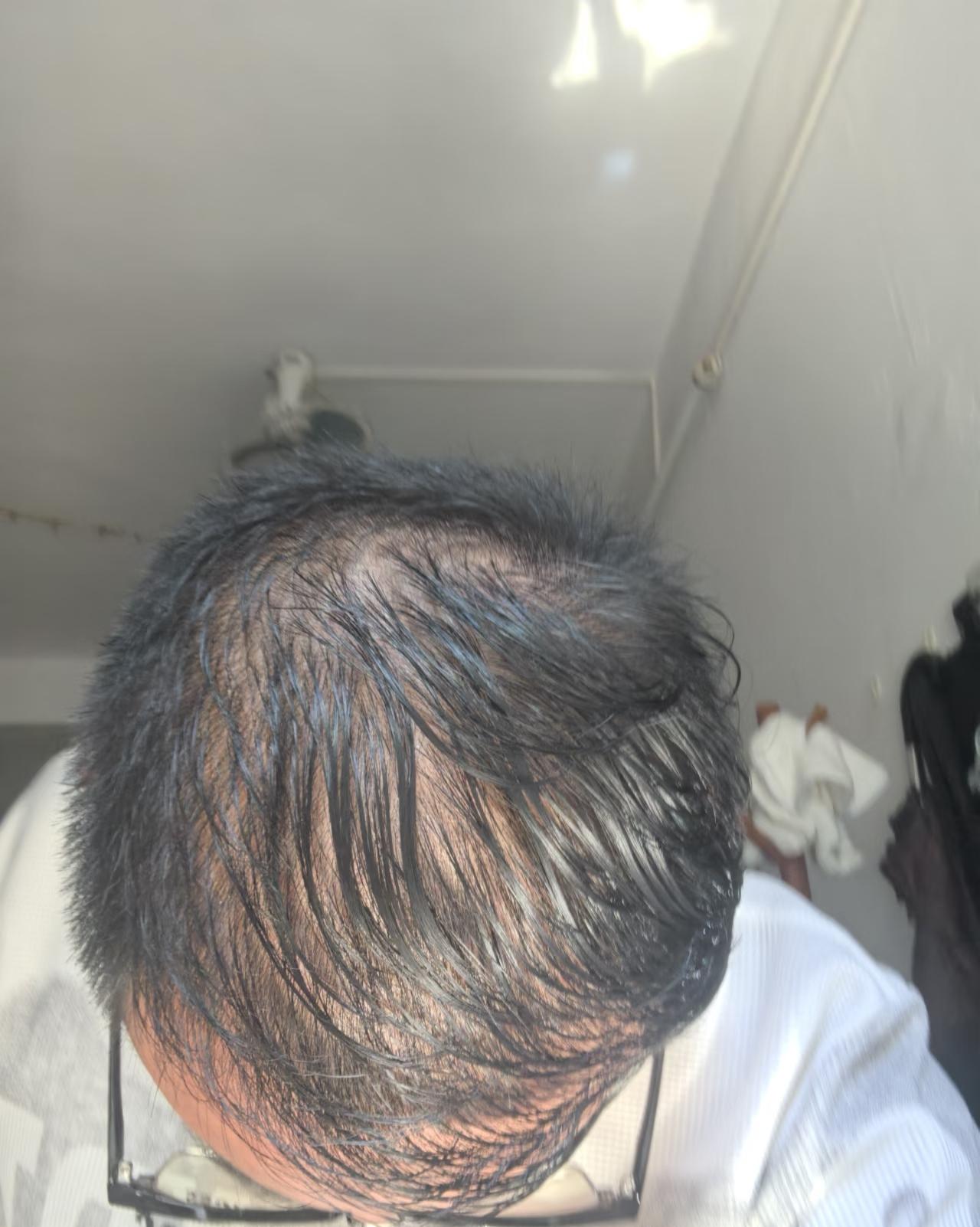 不是所有脱发都叫“脂溢性脱发”！认准M型、头顶O型，你的头发还有救男性秃顶，其