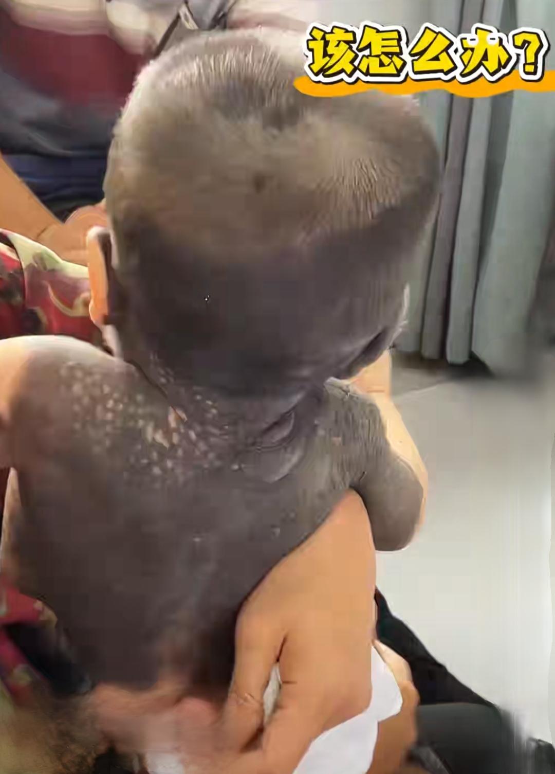 宝宝产检一切正常出生后满身黑兽皮痣，妈妈说几乎90％都是近日一河南妈妈的视频，