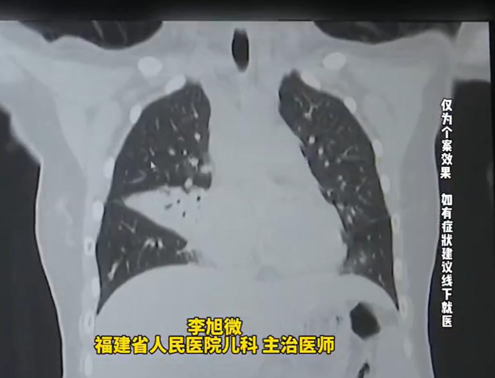 近日，福建省福州市12岁的女孩小婷高烧40℃，服药后体温始终降不下去，家长带她去