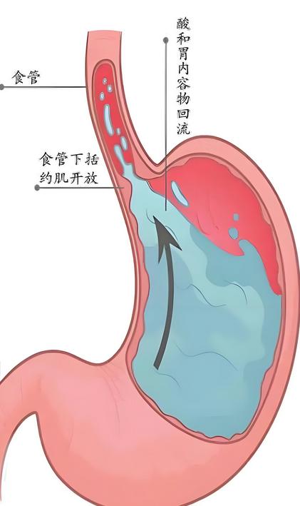 反酸像火烧是胃热，胃胀不消化是脾虚，喉咙发堵还是胃气上逆，一个方子把脾胃调顺，反