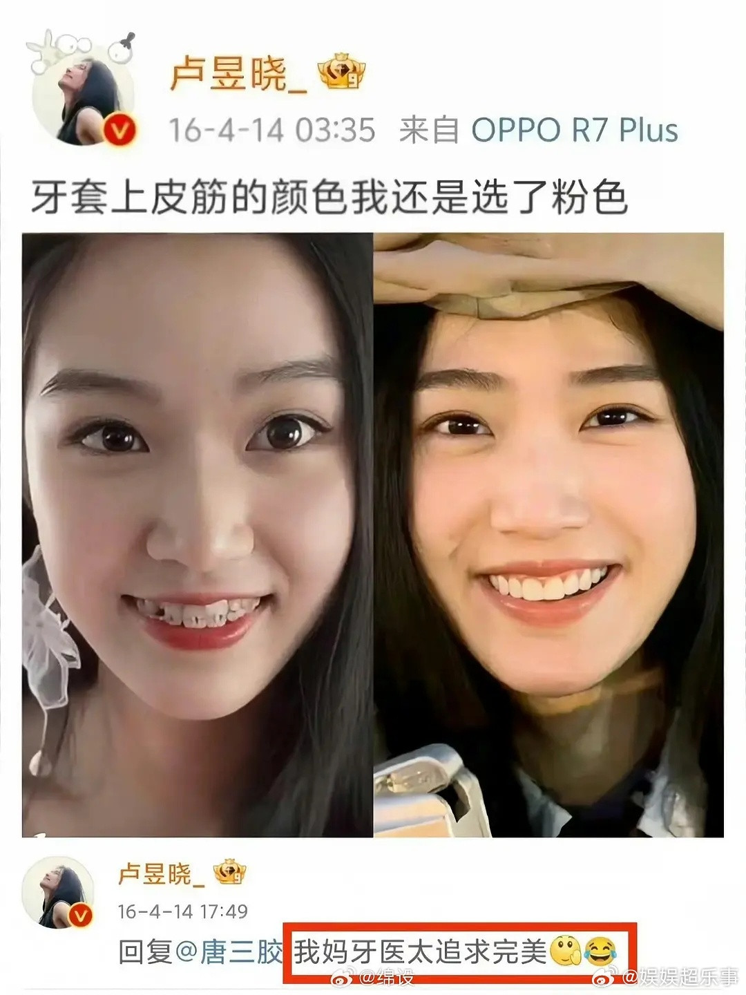 看了卢昱晓我知道了整牙还是很有用的