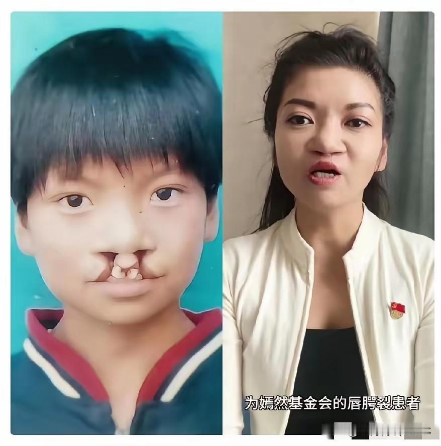 很多人都在质疑，李亚鹏当年免费救了7000多个唇腭裂孩子，现在医院遇难关，怎么没