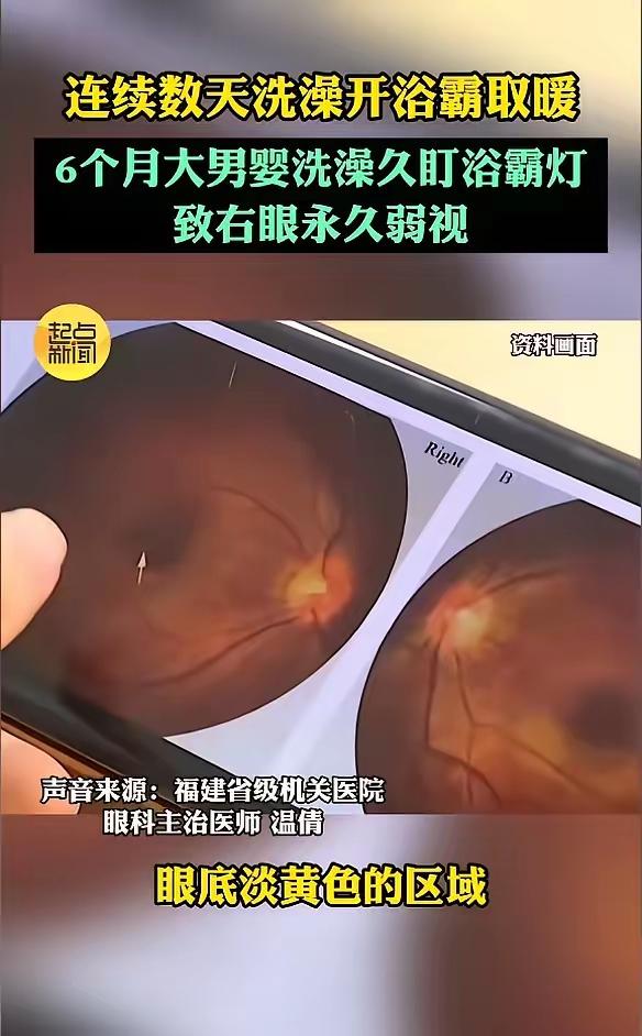 悲剧还是发生了！福建宝妈给6个月宝宝洗澡开浴霸，20天竟致孩子终身弱视，这波