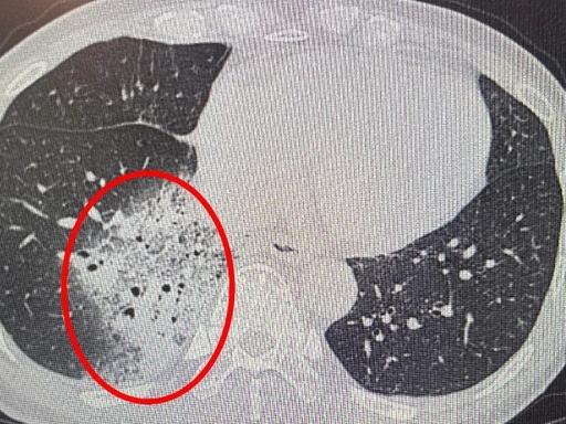 杭州一名老年女性开空调睡了一晚后，出现嗓子疼、浑身无力的症状。她以为只是普通感冒