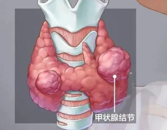 甲状腺癌提15年生存率与乳腺癌常提5年生存率: 差异背后的奥秘