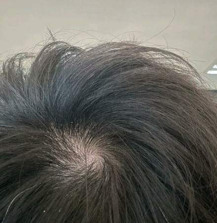 这是要秃了吗？
