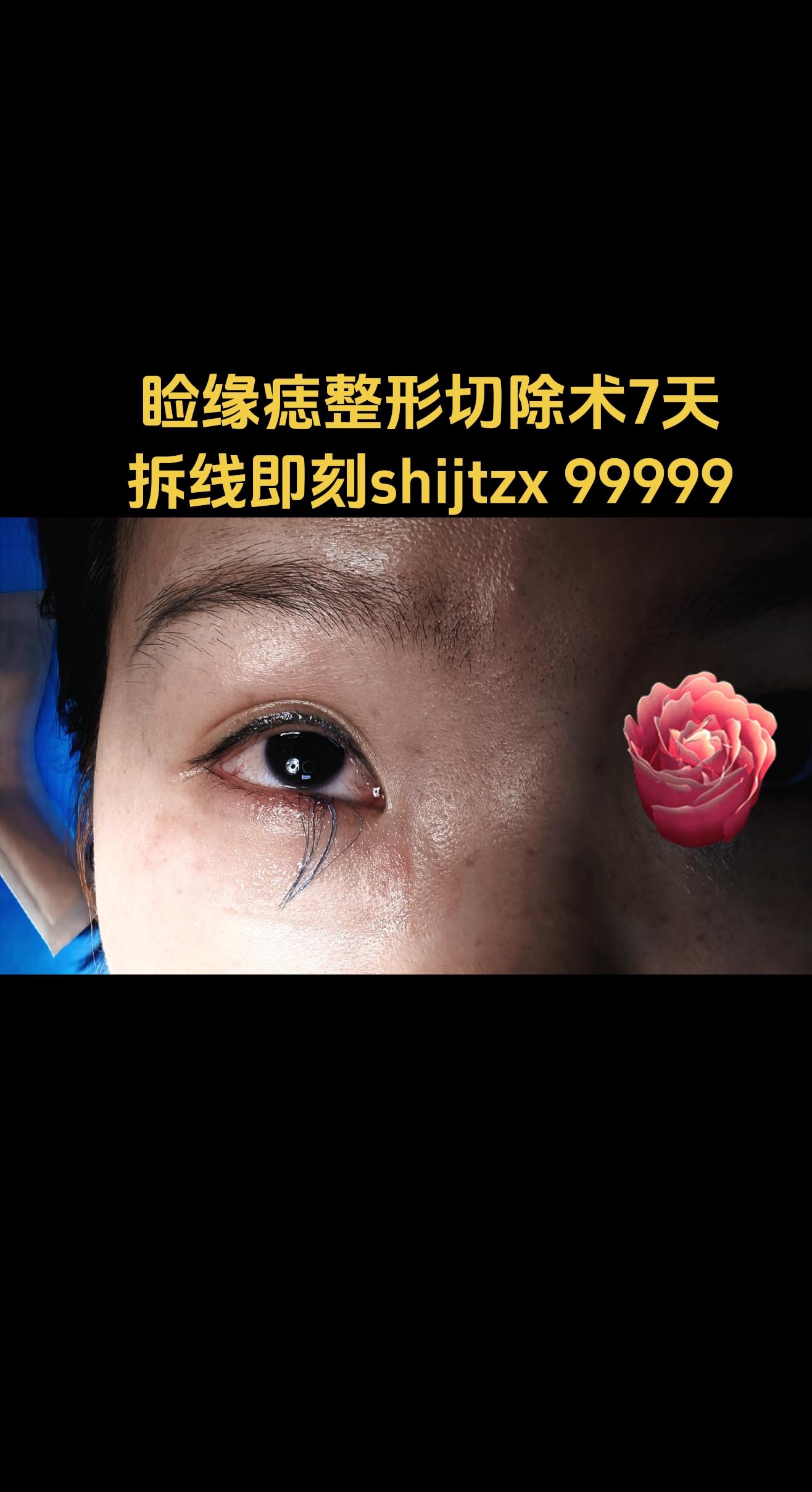 睑缘痣。睑缘痣整形切除加皮瓣修复术后7天拆线即刻。