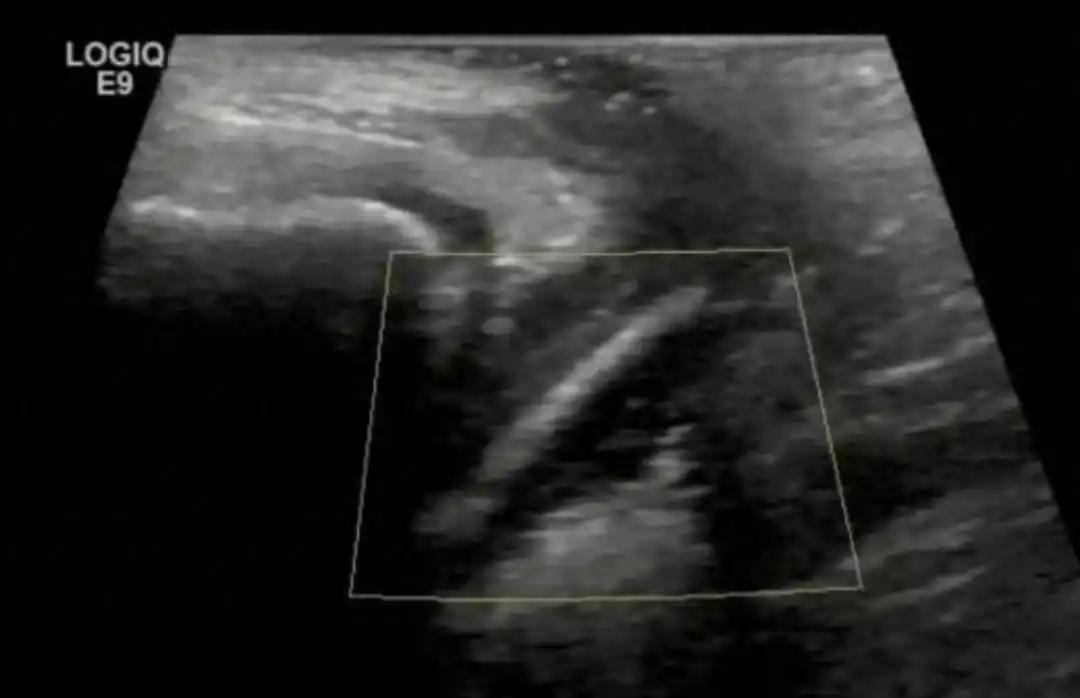 万万没想到！广东惠州，一名7岁女孩下体不舒服，妈妈一开始还没重视，以为抹抹药就好