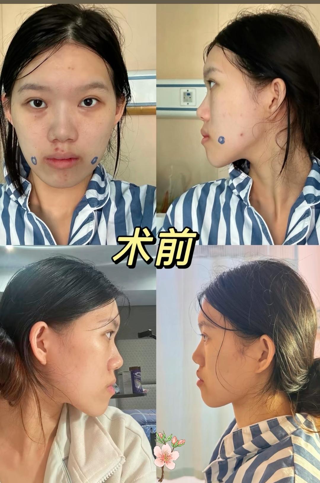 一句“现在的面型比之前更洋气”，直接把我看破防了！武汉小雨去武大口腔看牙，原本