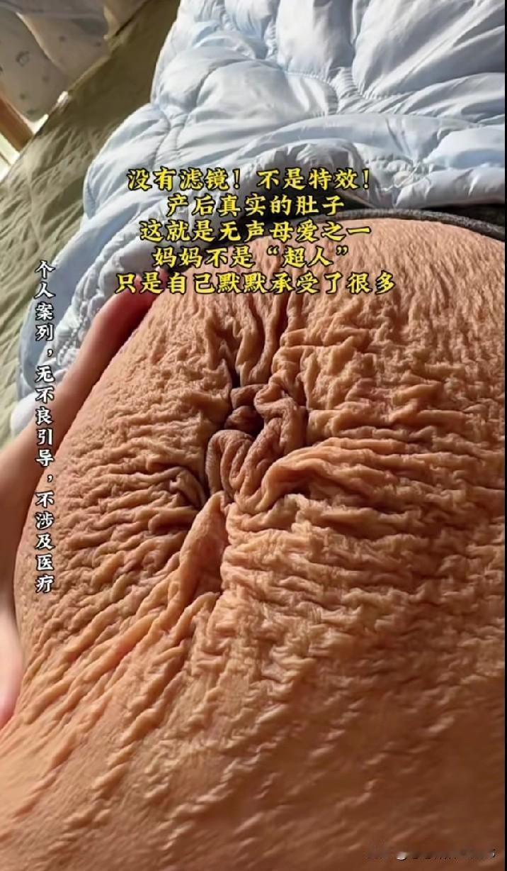 刚瞧见一位妈妈肚皮上的妊娠纹，由衷感叹当妈着实不易！妊娠纹的深浅各不相同，