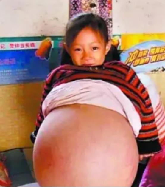 2010年，山西4岁女孩胡云星，肚子超大鼓胀得像孕妇。医生预言活不过三个月，就在