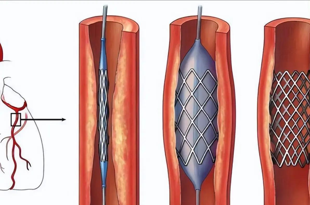 手术台上心血管重生，10年后50%桥管却悄然堵塞，患者直呼后悔莫及！心脏搭桥