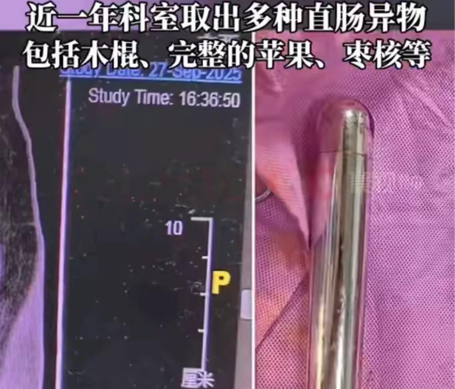 身体里去除异物，这是怎么进去的呢？