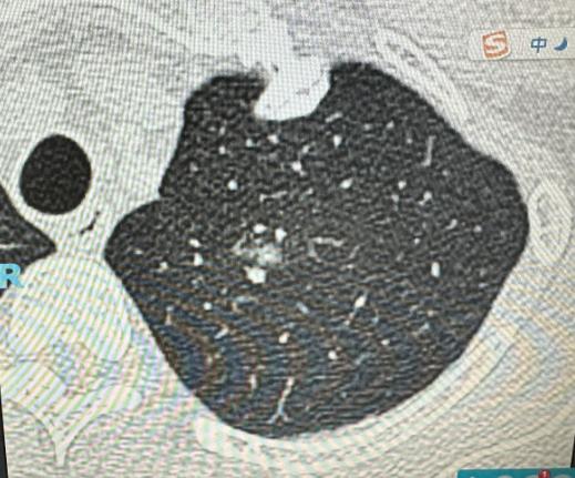 体检发现肺磨玻璃结节？别慌！大部分都是“好结节”！很多朋友体检做胸部CT，一看到