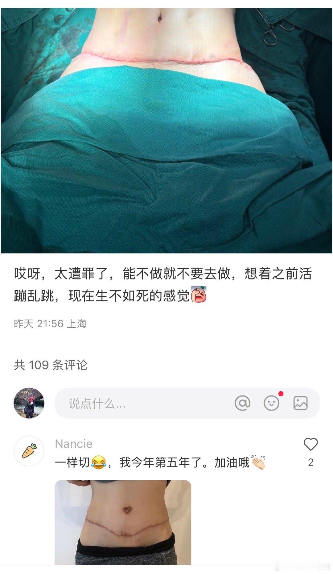 腹壁成形手术生完孩子肚子松弛，就切掉一些…生娃的代价太大了​​​