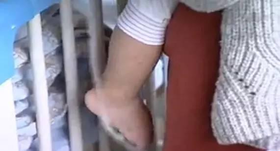 孩子都1岁了, 屁股长个红疙瘩后走路都走不动, 医生说不治就瘫痪