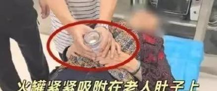 悲剧还是发生了！贵州贵阳，一七旬老人自行在家用塑料罐拔火罐，却因时间太久导致塑料