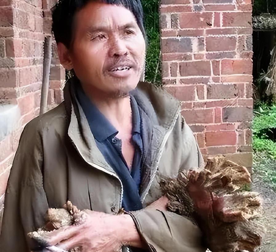 “我快要疼死了！”1992年，湖南小伙半夜惊醒，浑身火急火燎的疼，他开灯仔细一看