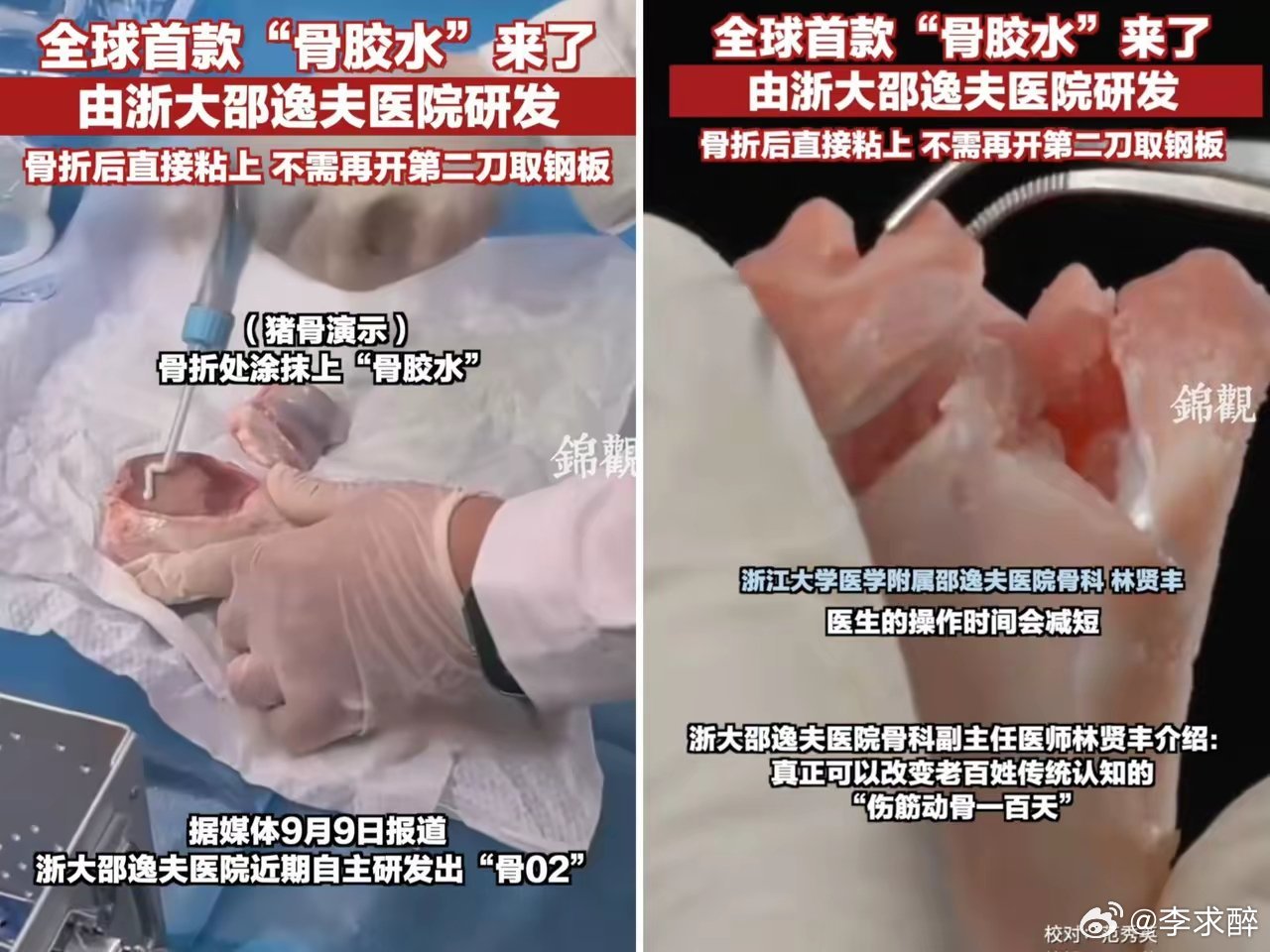 这下出名了，不仅中国，连全世界都要知道了。万万没想到，浙江邵逸夫医院研发出了全球