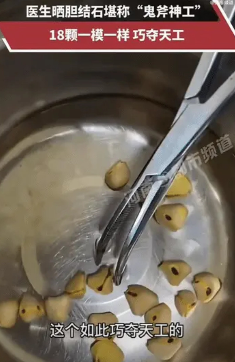 “这是活佛转世吧！”浙江一名医生遇到了一名胆结石患者，经过手术，成功的帮患者取出