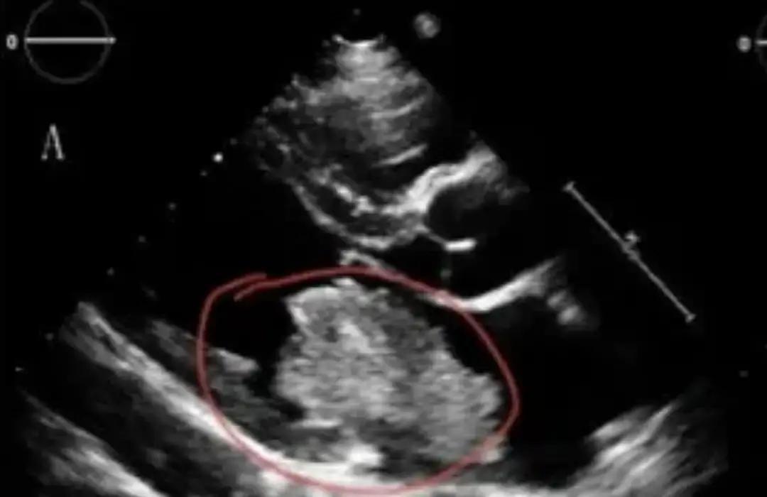 34岁的头胎孕妇差点被婆婆拉去引产，原因只是一张写着“房间隔膨出”的B超单。
