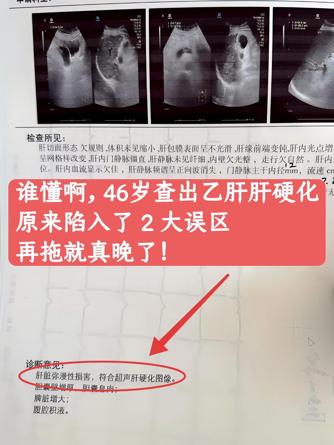 肝友们好，我是肝病介入张峰教授。有位 46 岁患者，已经是肝硬化晚期...