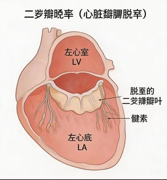 有些大医院的医生也会忽悠人，我有个同学40多岁时就得了心脏病，说是什么二尖瓣后叶