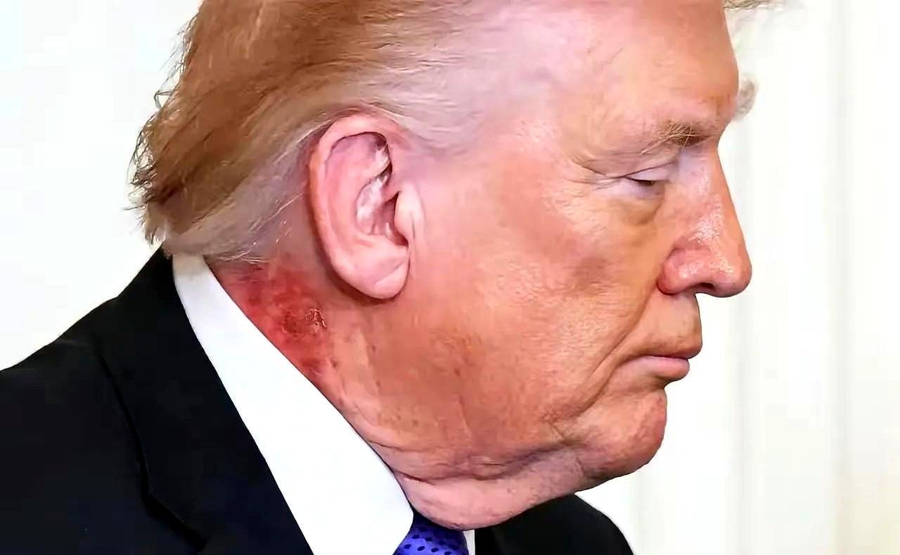 一个前总统的健康，从来不是医学问题，而是政治精算学。手背上的淤青，脖颈处的红