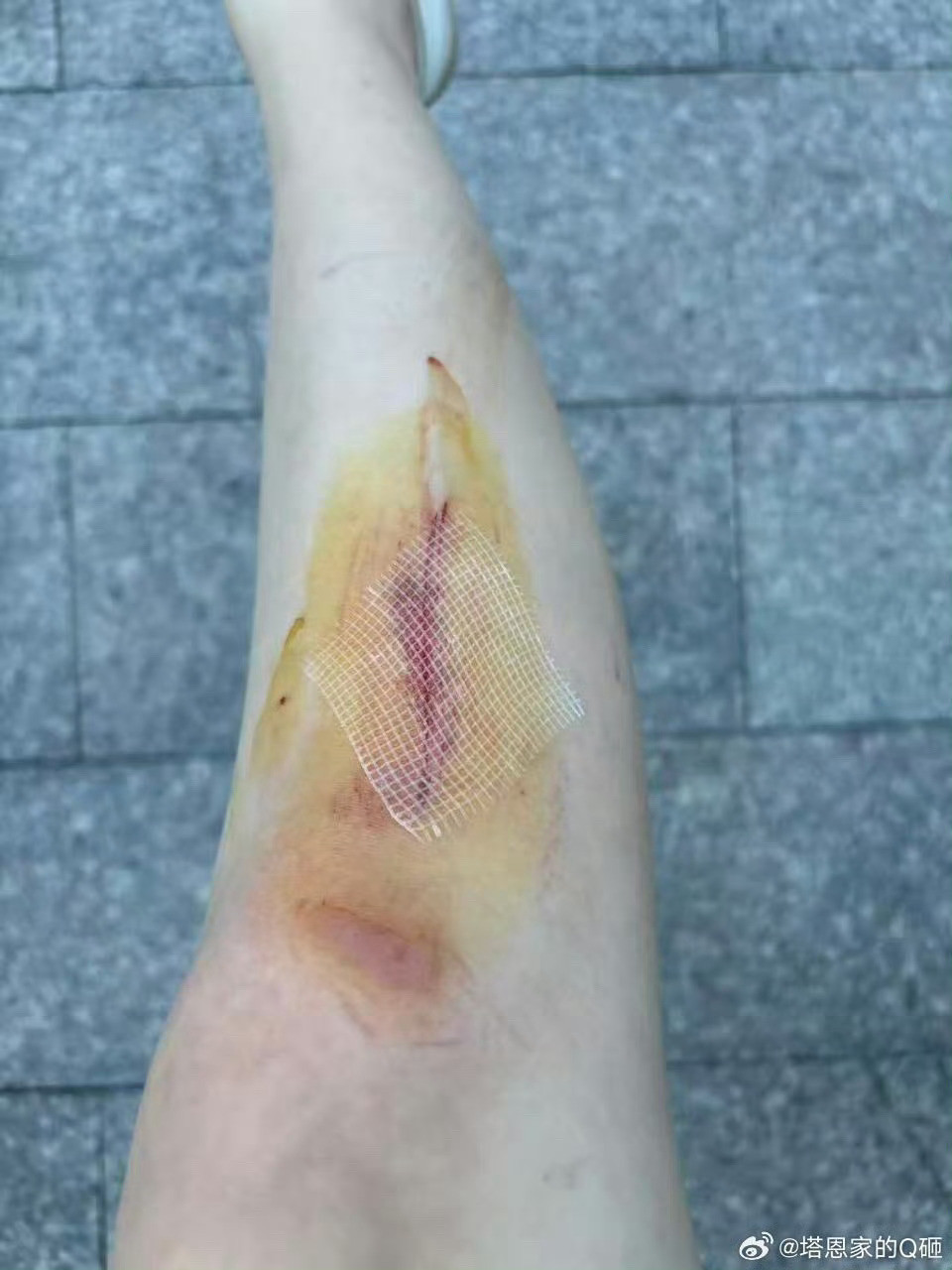 宁波网友在密室受伤商家让顾客自己去报警吧网友“塔恩家的Q砸”发帖投诉：【298元