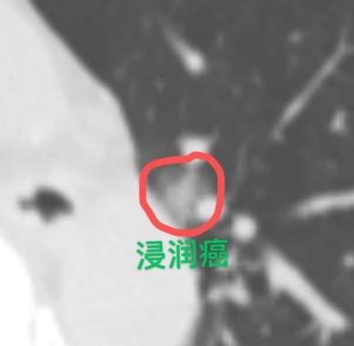 门诊来了一位患者，体检发现肺里有个9mm的结节，从形态上看考虑可能还是恶性的，我