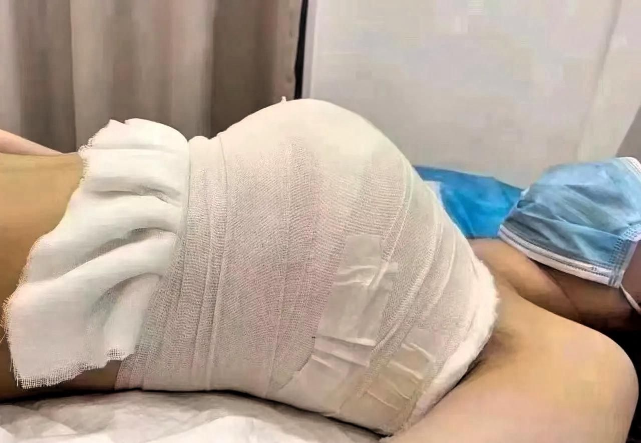 天塌了～刚隆胸手术7天就发现怀孕了，还是双胞胎！昆明张女士的遭遇，让人倍感纠