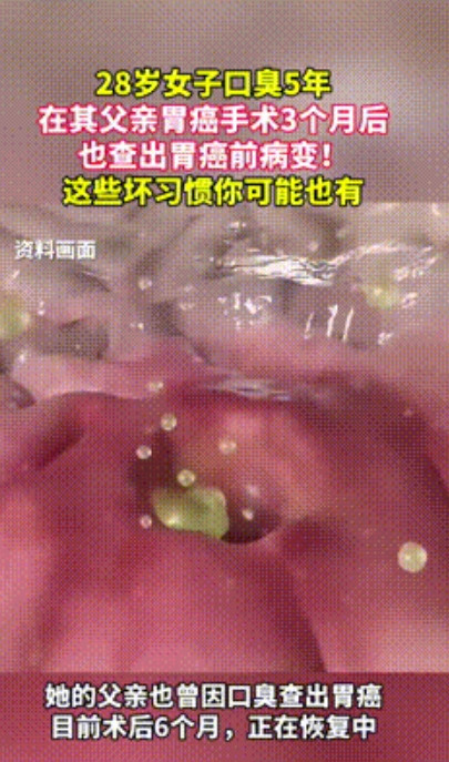 “解释不清了！”河南，父亲胃癌动了手术，不料，3个月后28岁女儿因口臭，也查出胃
