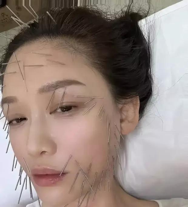 看到陈乔恩满脸扎针的模样看着都觉得疼不是说很多女孩子都怕疼的吗这妥妥的女汉