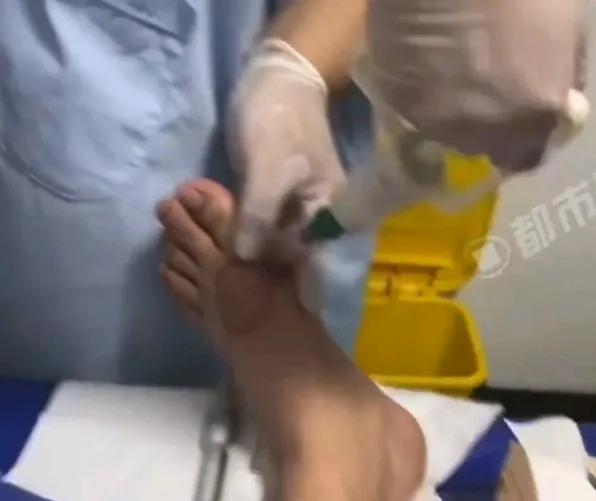 痛风这事儿，真得防着点。34岁男子吃荔枝后痛风发作，疼得没法走路。还有56岁的刘