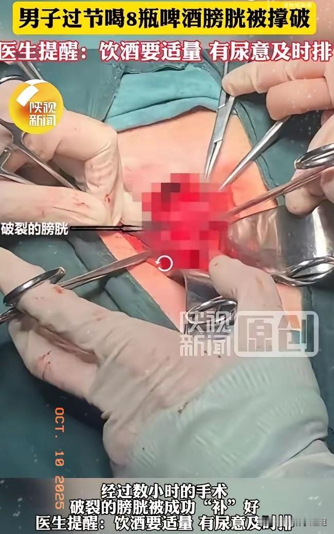 男子喝8瓶啤酒把膀胱“撑破”近日有位男士在节日期间豪饮8瓶啤酒，因未及时排尿