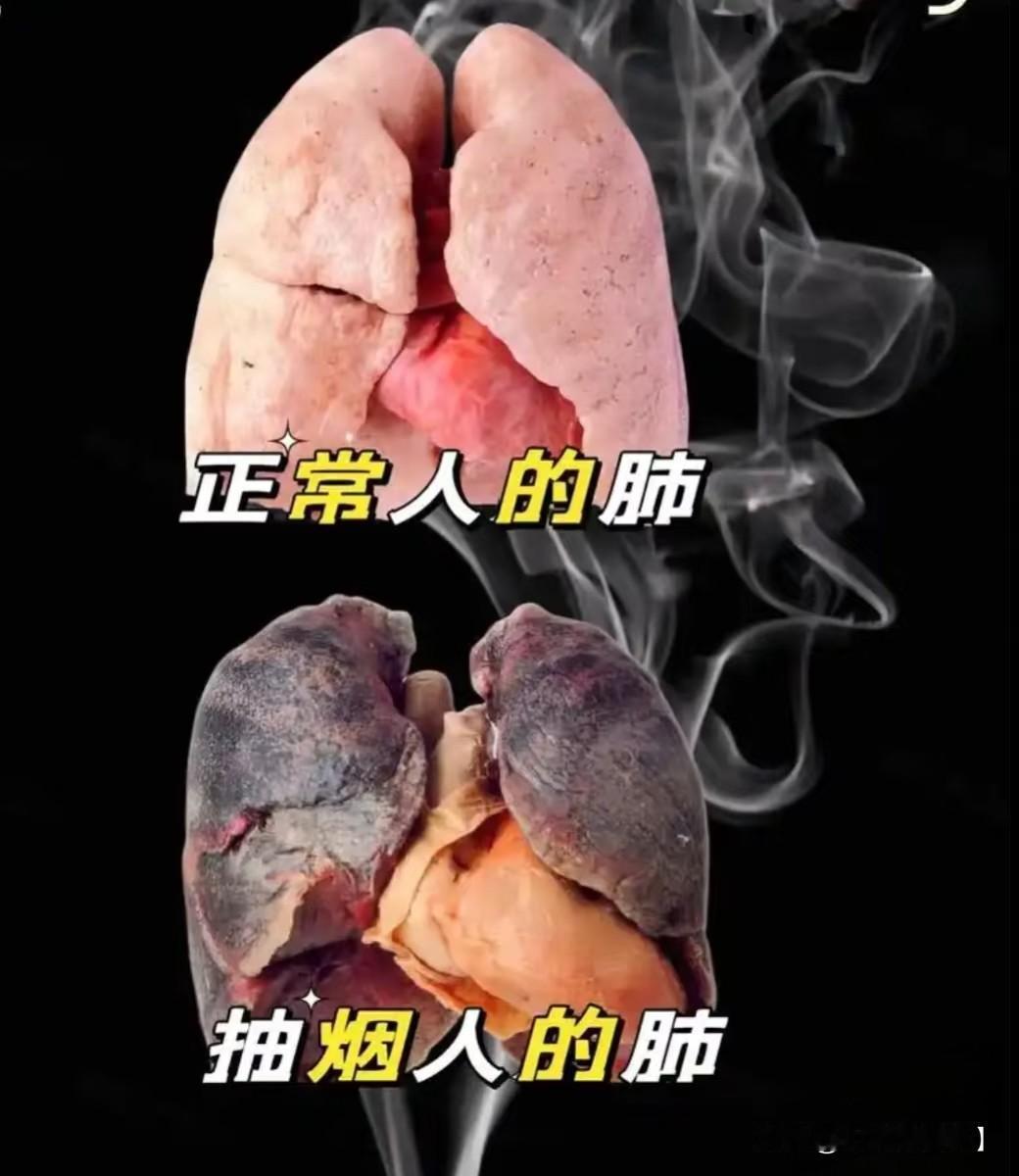 20岁确诊，吸烟8年，意味着他12岁就开始接触烟草。这在现实中极不寻常，更可能是
