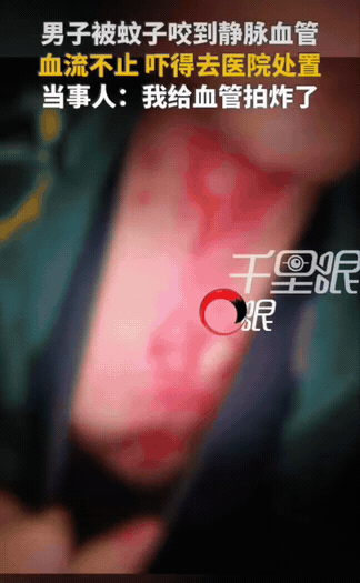 上海，一个男生练完健身打车回家，等车的时候脖子被蚊子叮了，看见蚊子趴在皮肤上吸血