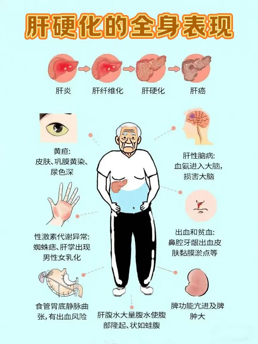 肝硬化的全身表现！