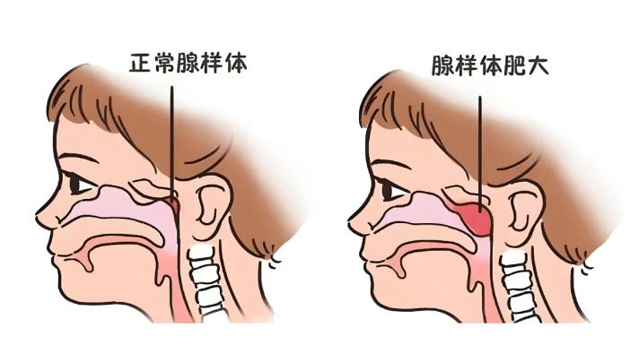 腺样体肥大的两个根源，这样就好理解了最近好多家长私信问：“孩子上次感冒后，睡觉