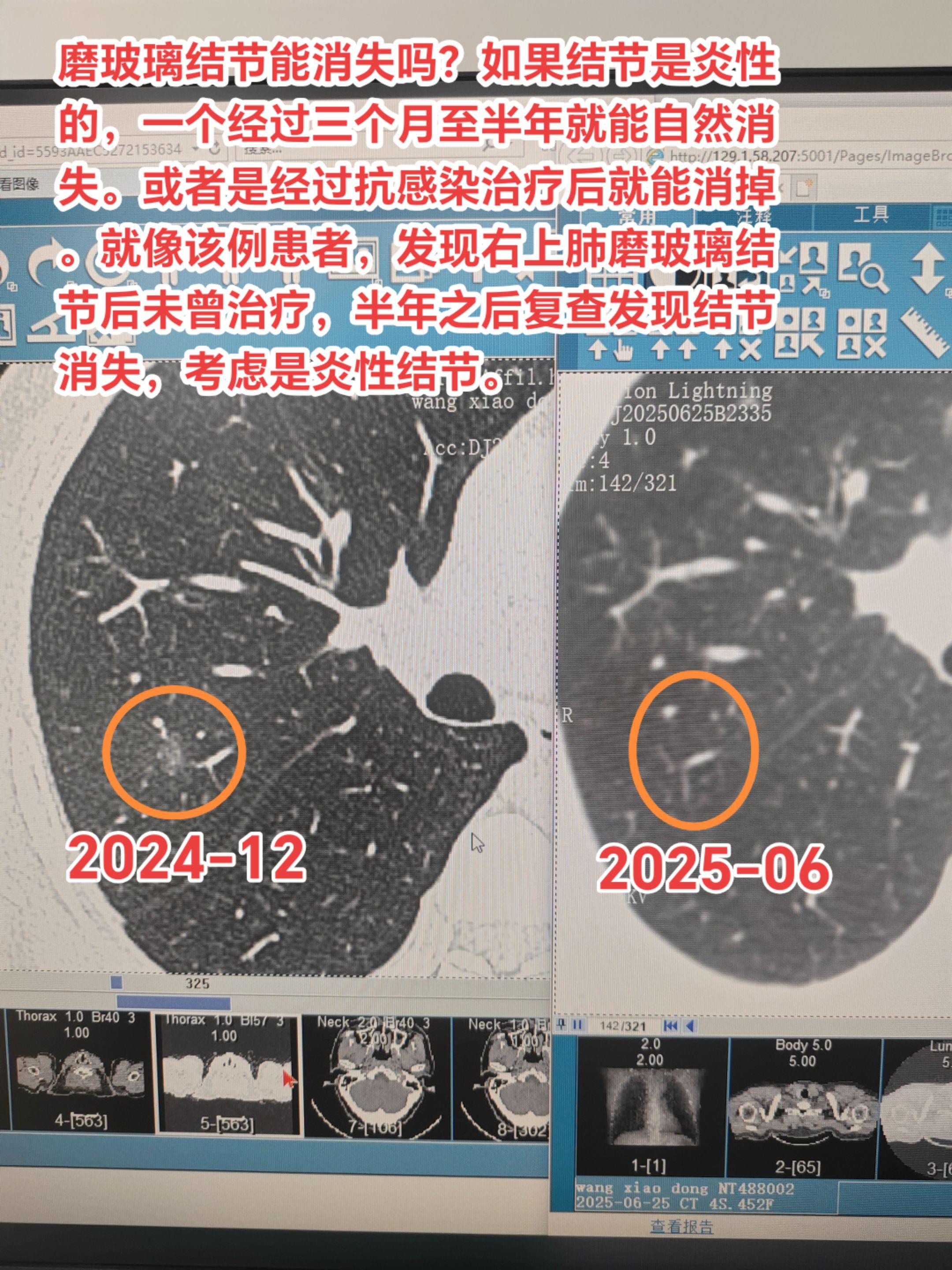 磨玻璃结节能消失吗？如果结节是炎性的，一个经过三个月至半年就能自然消失...
