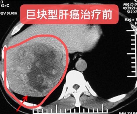 巨块型肝癌的转化治疗。男性，58岁，乙肝所致肝癌，肝右叶巨块型肝癌 1...