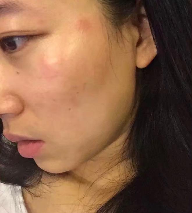 长途旅行中皮肤过敏怎么办? 这几个妙招你要记得!