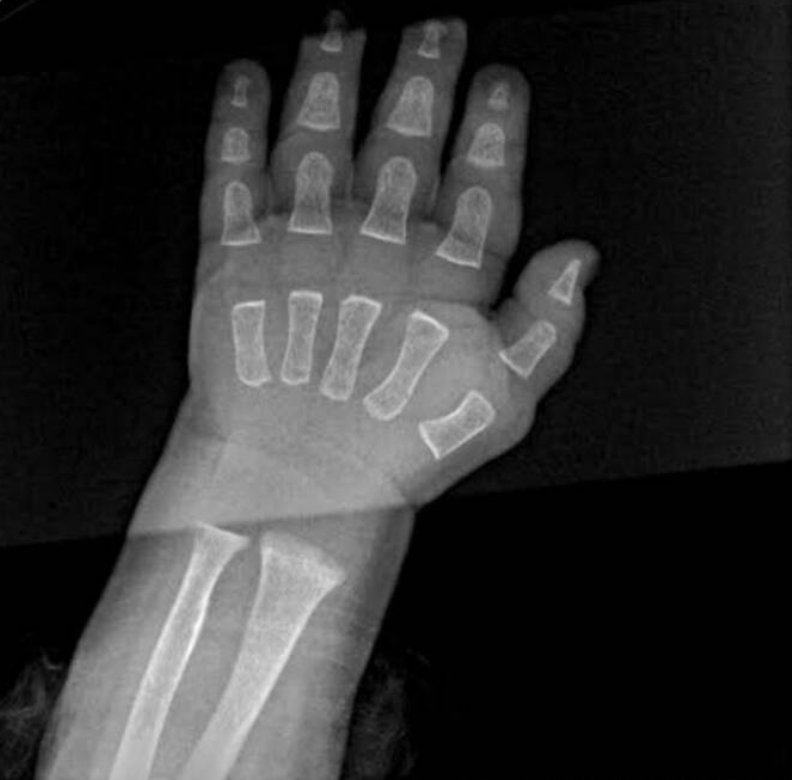 婴儿的手部x光片