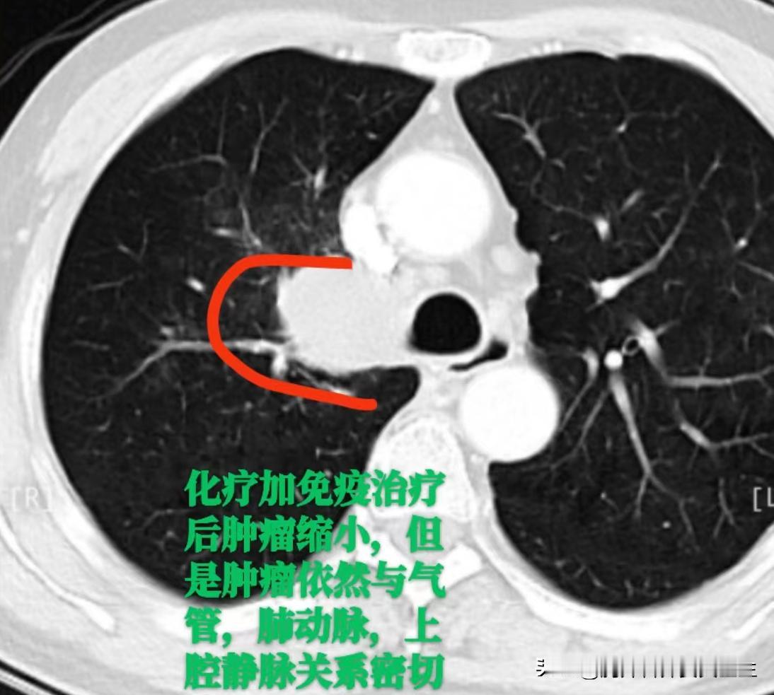这个病例让我特别感动！通过远程会诊认识了一位64岁的珠海患者。老人家右上肺长了个