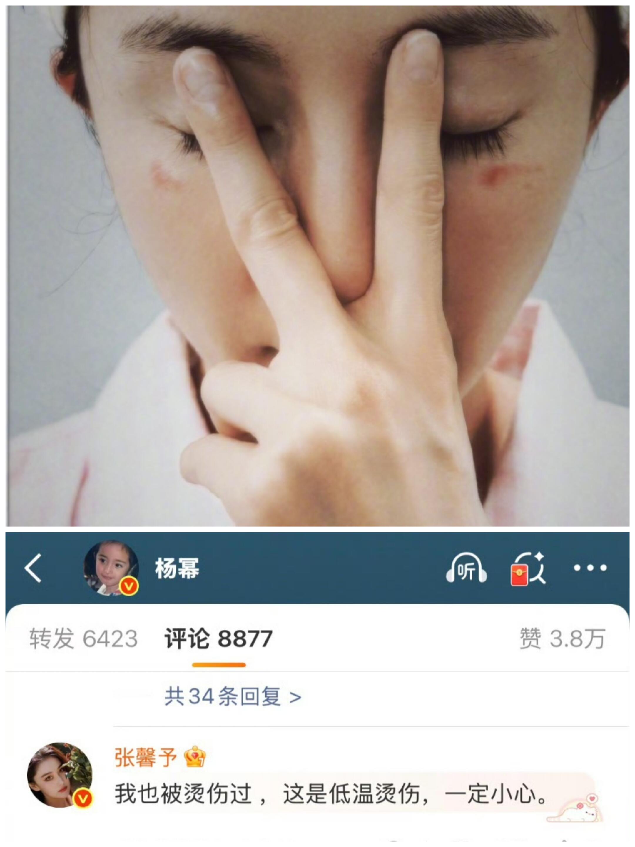 杨幂脸被蒸汽眼罩烫伤了热水袋、暖宝宝、电热毯，冬天贴身取暖的东西我都被烫过，你