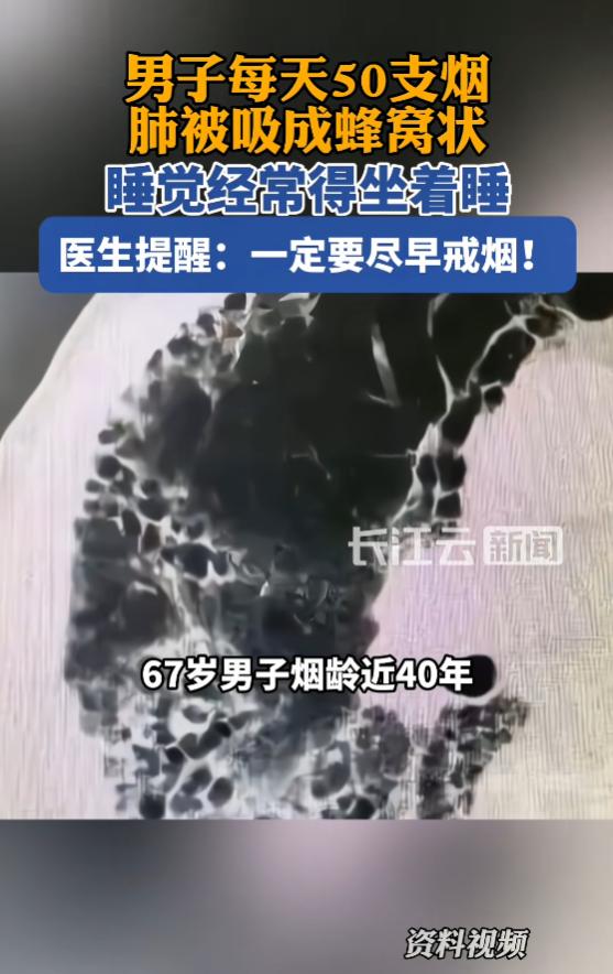 “太惨了！”8月13日报道，河南，一男子是老烟民，几乎每天都要抽50支，这导致他